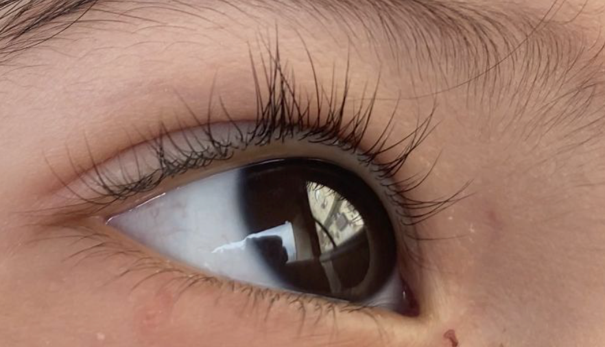 Can Children Get Cataracts? Here’s What Parents Should Know.