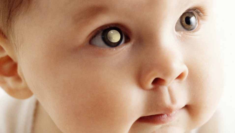 White Pupil in Children: What This May Mean